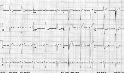 causes of lv hypertrophy|qrs widening and repolarization abnormality.